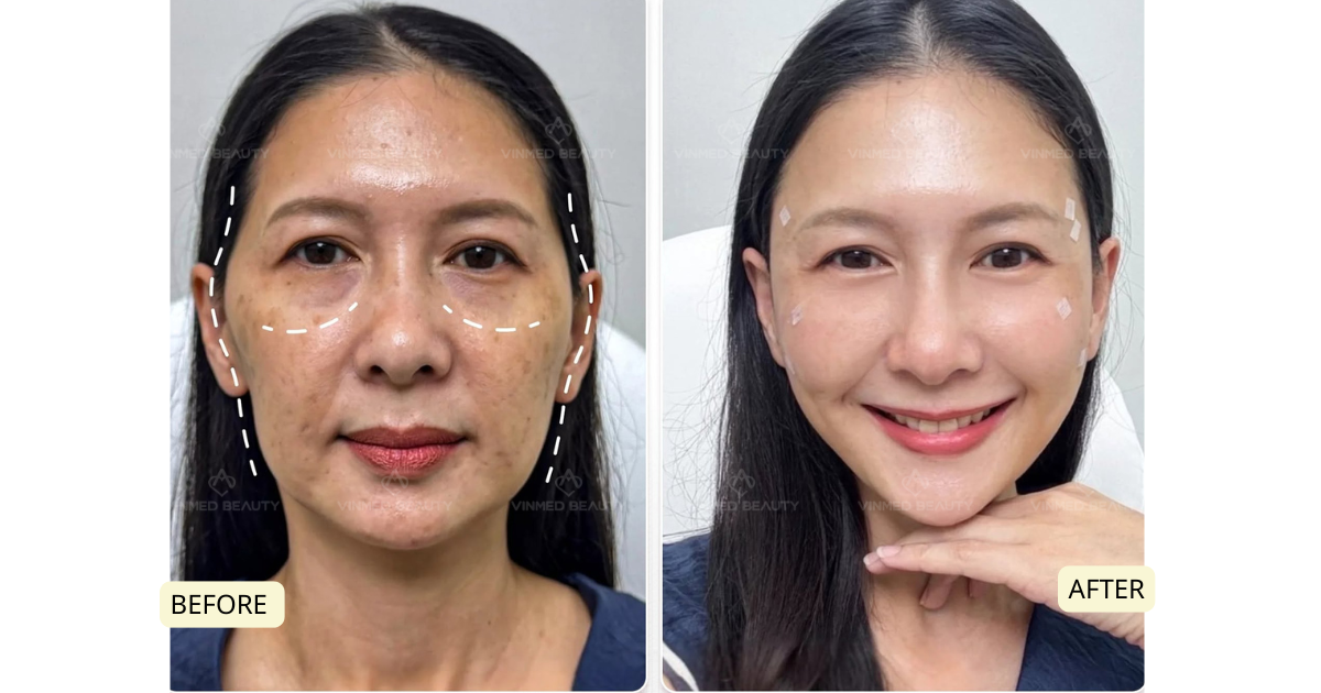 Radiance & texture renewal